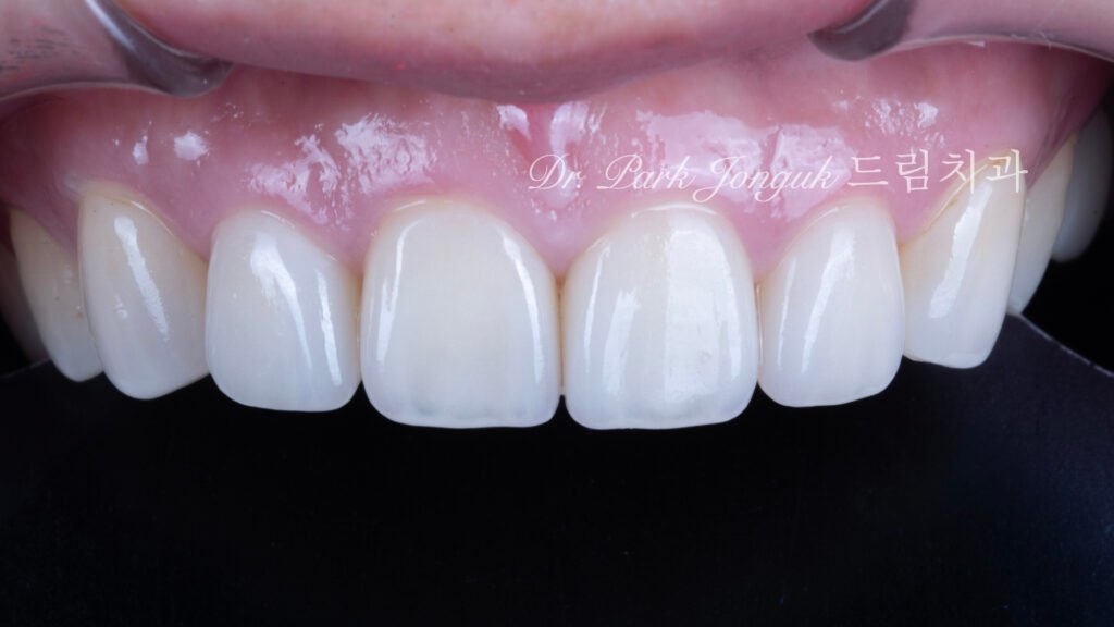 50대라미네이트, 치아노화라미네이트, 치아마모라미네이트, AgingTeeth, LaminateVeneers, ToothWear, 심미치과, 앞니라미네이트, 자연스러운라미네이트, 동안치아