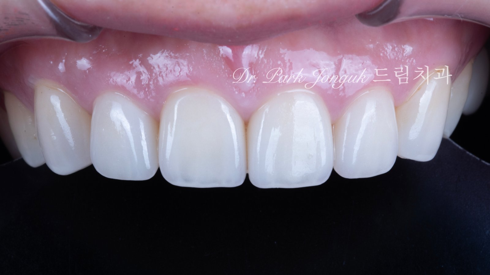 50대라미네이트, 치아노화라미네이트, 치아마모라미네이트, AgingTeeth, LaminateVeneers, ToothWear, 심미치과, 앞니라미네이트, 자연스러운라미네이트, 동안치아