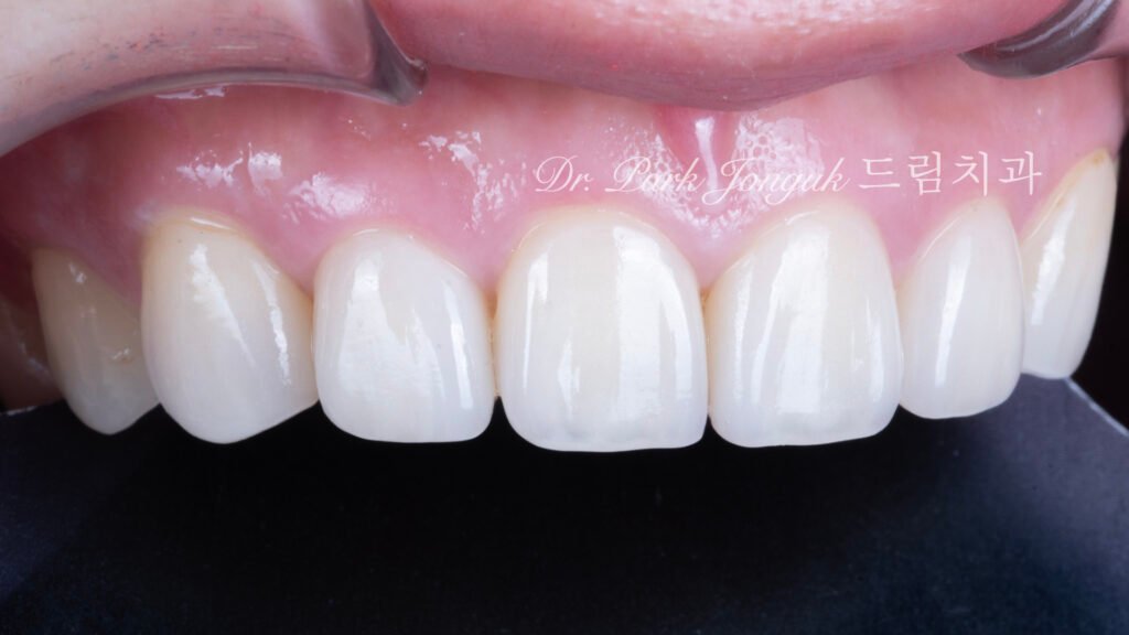 50대라미네이트, 치아노화라미네이트, 치아마모라미네이트, AgingTeeth, LaminateVeneers, ToothWear, 심미치과, 앞니라미네이트, 자연스러운라미네이트, 동안치아