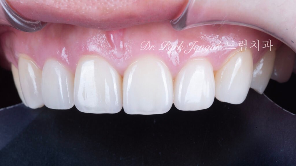 50대라미네이트, 치아노화라미네이트, 치아마모라미네이트, AgingTeeth, LaminateVeneers, ToothWear, 심미치과, 앞니라미네이트, 자연스러운라미네이트, 동안치아