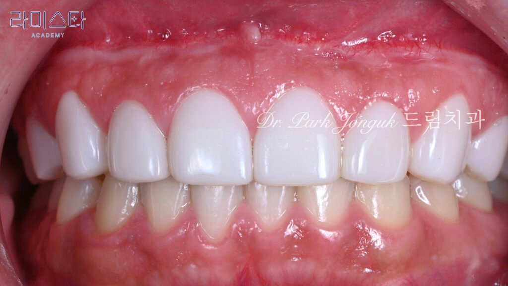 라미네이트 제작 방법, Laminate Fabrication Methods, 수작업 빌드업, Hand-Layered Build-up, CAD/CAM 밀링, CAD/CAM Milling, E-max 베이스, E-max Base, 자연스러운 라미네이트, Natural Laminate