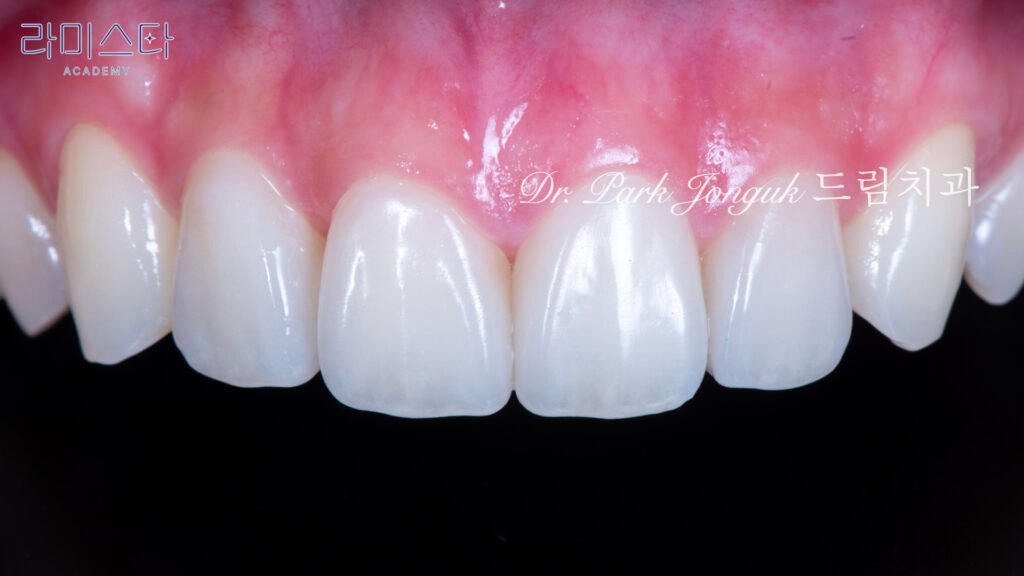 라미네이트 제작 방법, Laminate Fabrication Methods, 수작업 빌드업, Hand-Layered Build-up, CAD/CAM 밀링, CAD/CAM Milling, E-max 베이스, E-max Base, 자연스러운 라미네이트, Natural Laminate