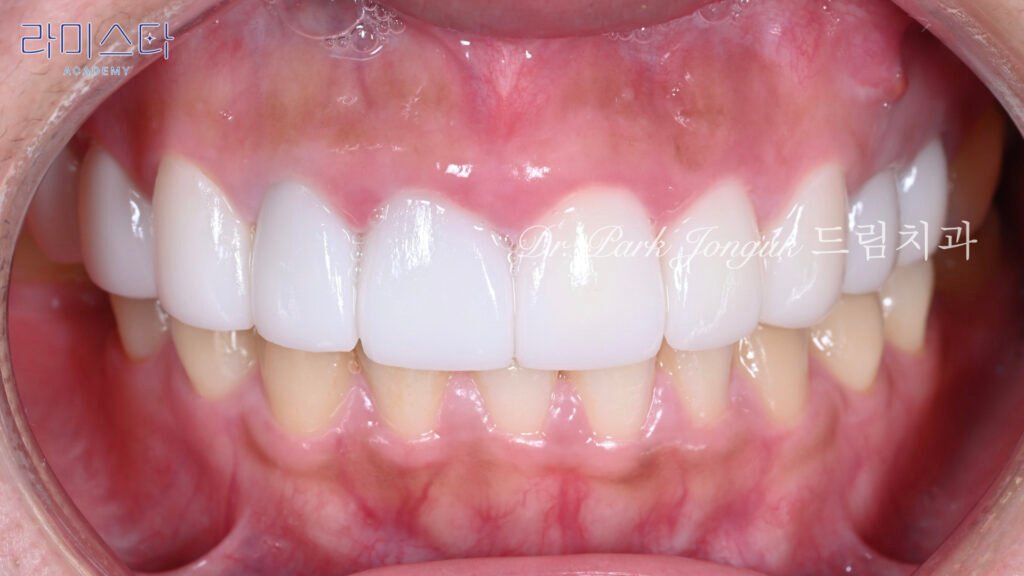 라미네이트 제작 방법, Laminate Fabrication Methods, 수작업 빌드업, Hand-Layered Build-up, CAD/CAM 밀링, CAD/CAM Milling, E-max 베이스, E-max Base, 자연스러운 라미네이트, Natural Laminate