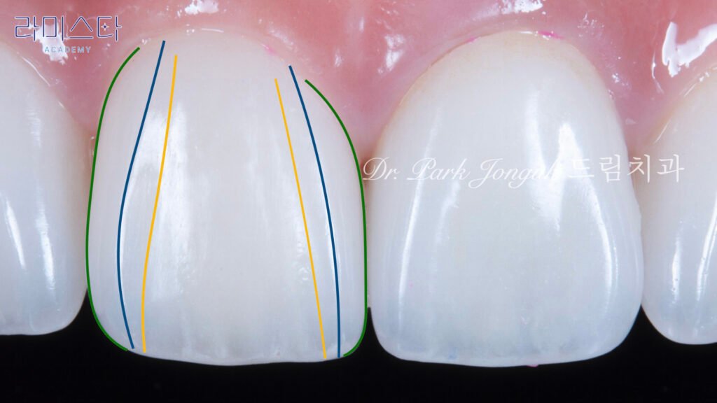 라미네이트 제작 방법, Laminate Fabrication Methods, 수작업 빌드업, Hand-Layered Build-up, CAD/CAM 밀링, CAD/CAM Milling, E-max 베이스, E-max Base, 자연스러운 라미네이트, Natural Laminate