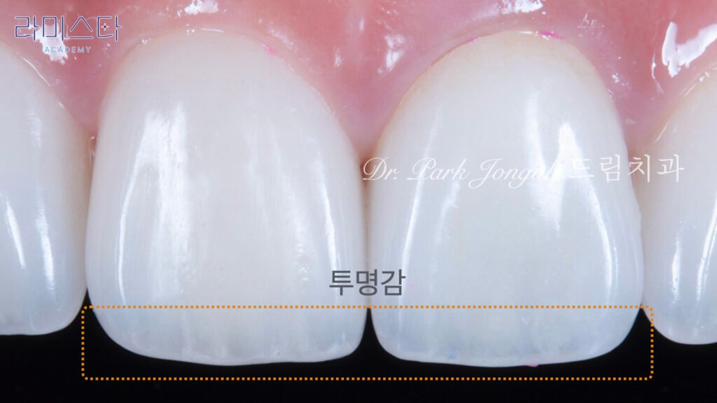 라미네이트 제작 방법, Laminate Fabrication Methods, 수작업 빌드업, Hand-Layered Build-up, CAD/CAM 밀링, CAD/CAM Milling, E-max 베이스, E-max Base, 자연스러운 라미네이트, Natural Laminate