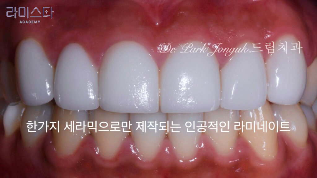 라미네이트 제작 방법, Laminate Fabrication Methods, 수작업 빌드업, Hand-Layered Build-up, CAD/CAM 밀링, CAD/CAM Milling, E-max 베이스, E-max Base, 자연스러운 라미네이트, Natural Laminate