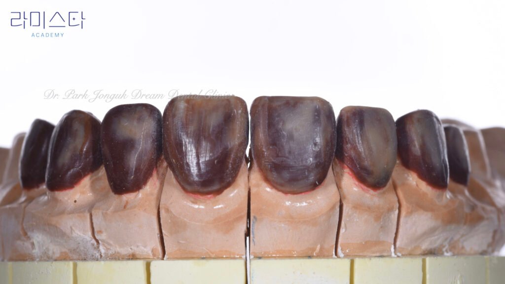 라미네이트 제작 방법, Laminate Fabrication Methods, 수작업 빌드업, Hand-Layered Build-up, CAD/CAM 밀링, CAD/CAM Milling, E-max 베이스, E-max Base, 자연스러운 라미네이트, Natural Laminate