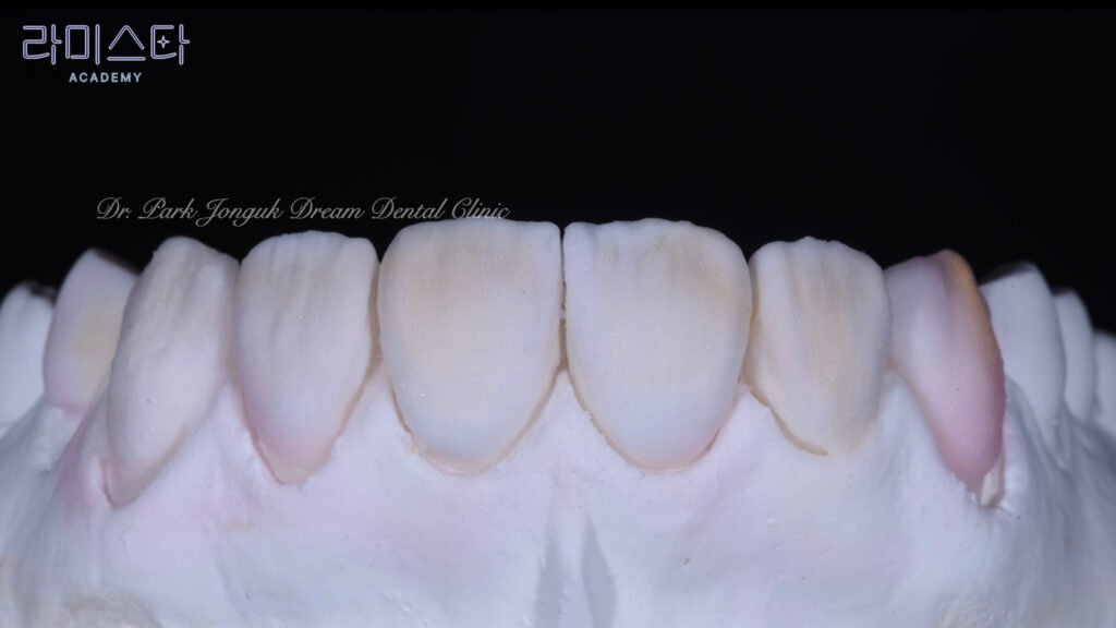 라미네이트 제작 방법, Laminate Fabrication Methods, 수작업 빌드업, Hand-Layered Build-up, CAD/CAM 밀링, CAD/CAM Milling, E-max 베이스, E-max Base, 자연스러운 라미네이트, Natural Laminate