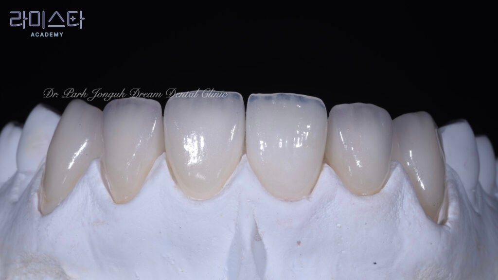 라미네이트 제작 방법, Laminate Fabrication Methods, 수작업 빌드업, Hand-Layered Build-up, CAD/CAM 밀링, CAD/CAM Milling, E-max 베이스, E-max Base, 자연스러운 라미네이트, Natural Laminate