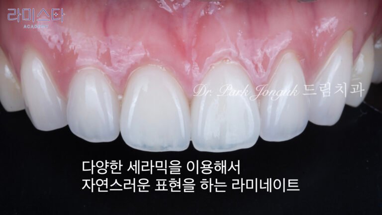 라미네이트 제작 방법, Laminate Fabrication Methods, 수작업 빌드업, Hand-Layered Build-up, CAD/CAM 밀링, CAD/CAM Milling, E-max 베이스, E-max Base, 자연스러운 라미네이트, Natural Laminate