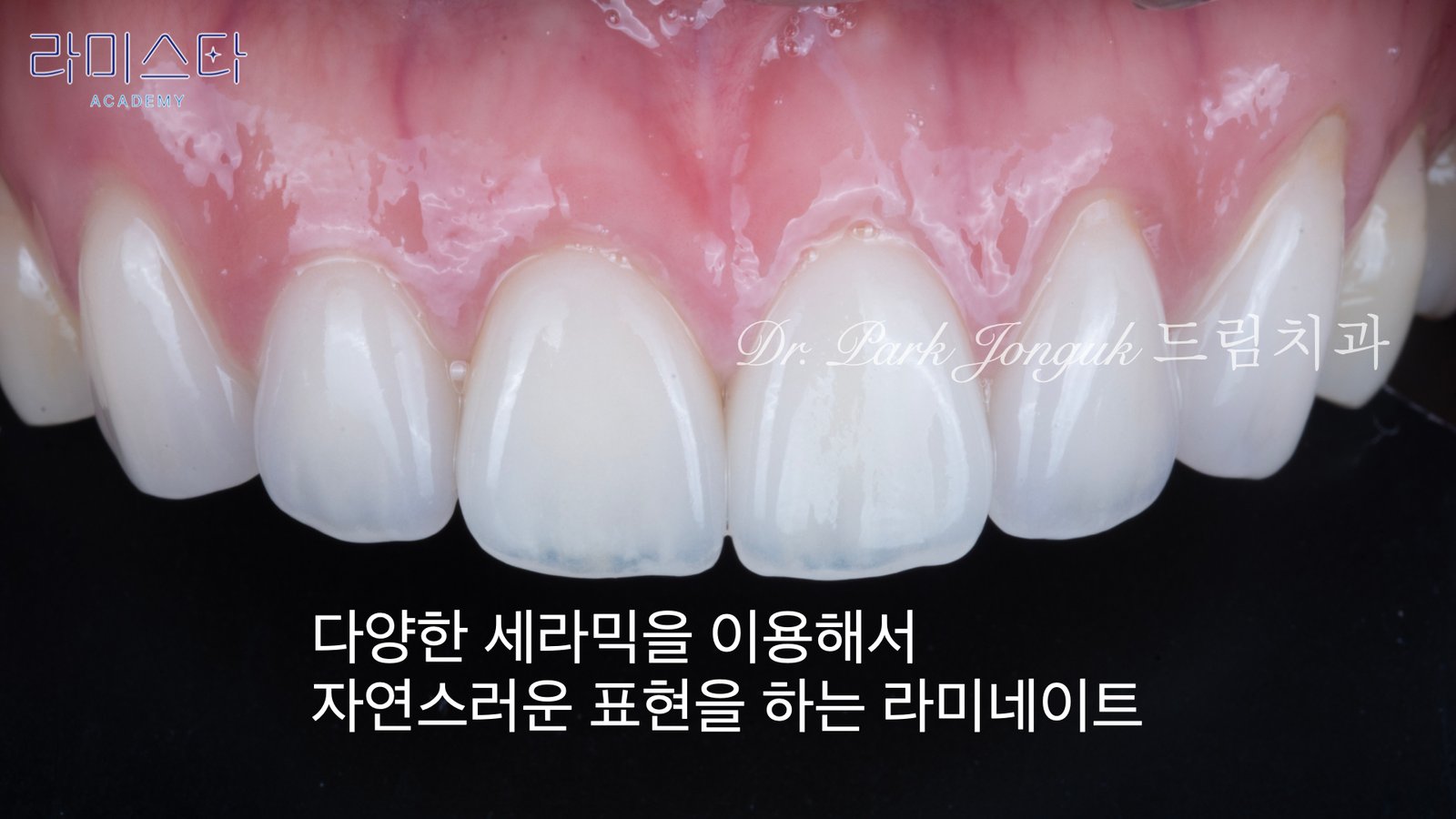 라미네이트 제작 방법, Laminate Fabrication Methods, 수작업 빌드업, Hand-Layered Build-up, CAD/CAM 밀링, CAD/CAM Milling, E-max 베이스, E-max Base, 자연스러운 라미네이트, Natural Laminate