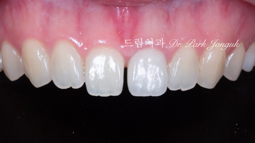 올세라믹 크라운 재시술과 무삭제 라미네이트 치료