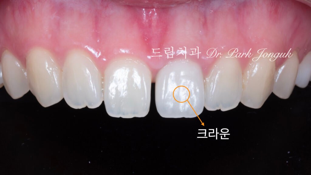 올세라믹 크라운 재시술과 무삭제 라미네이트 치료