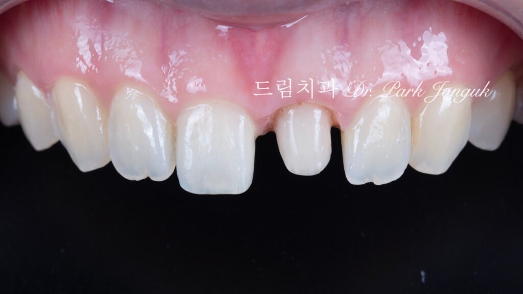 올세라믹 크라운 재시술과 무삭제 라미네이트 치료