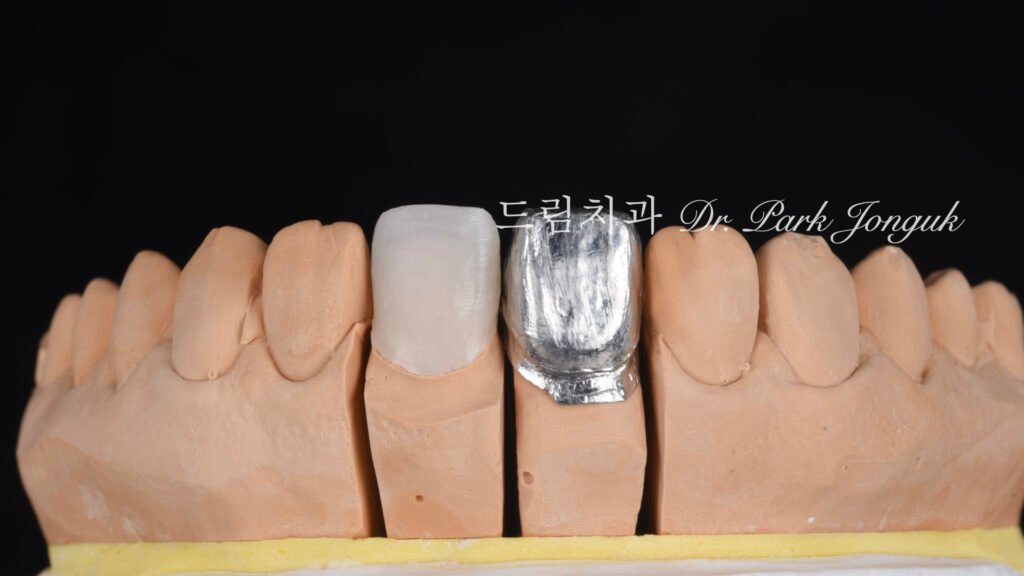 올세라믹 크라운 재시술과 무삭제 라미네이트 치료
