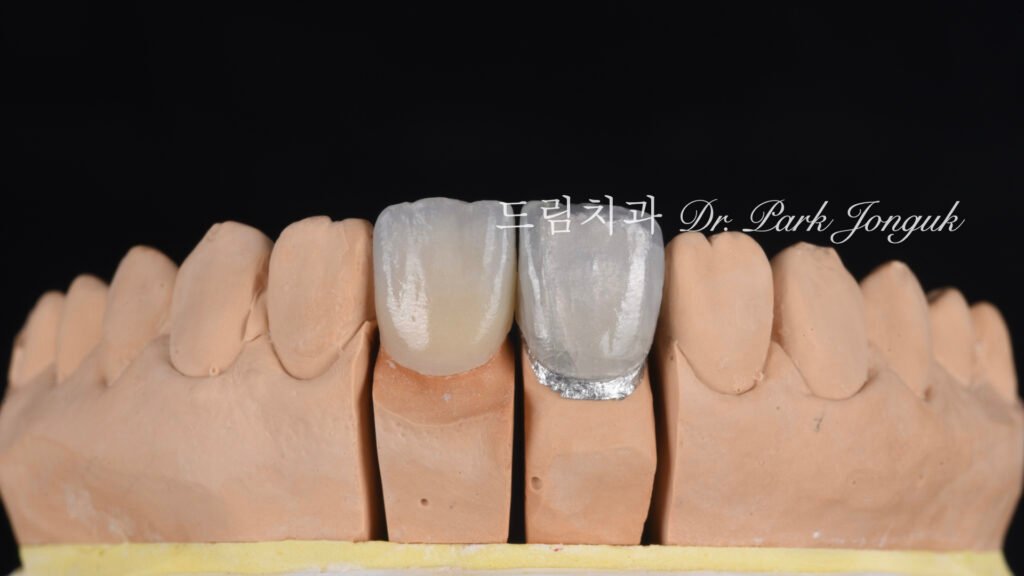 올세라믹 크라운 재시술과 무삭제 라미네이트 치료