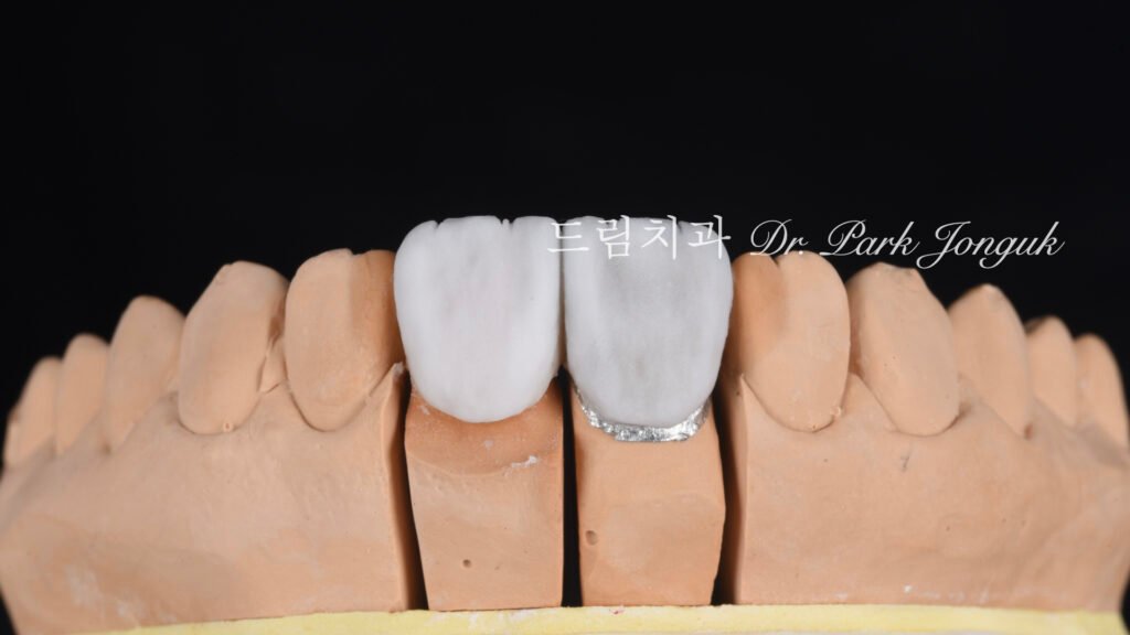 올세라믹 크라운 재시술과 무삭제 라미네이트 치료
