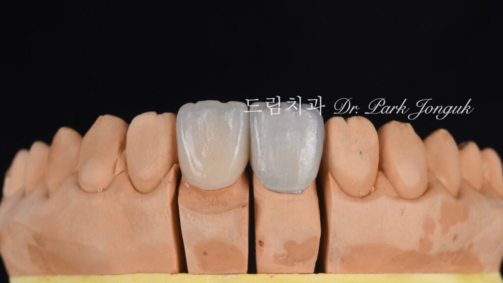 올세라믹 크라운 재시술과 무삭제 라미네이트 치료