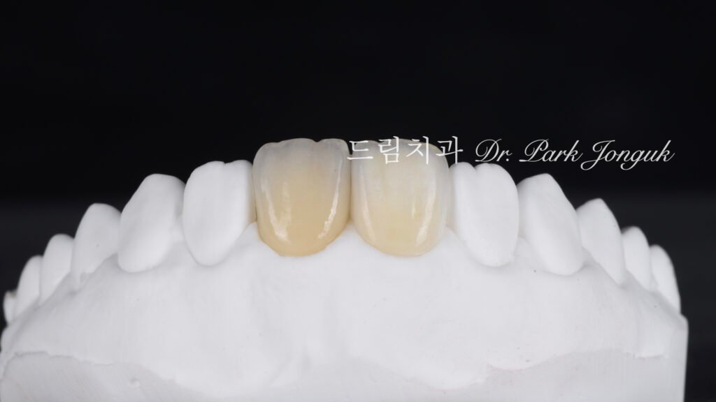 올세라믹 크라운 재시술과 무삭제 라미네이트 치료