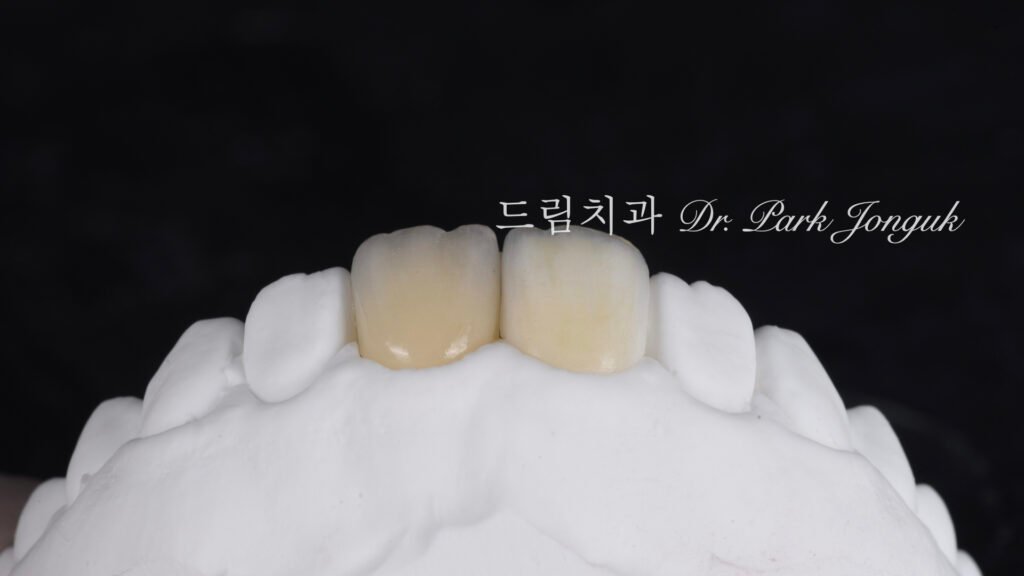 올세라믹 크라운 재시술과 무삭제 라미네이트 치료