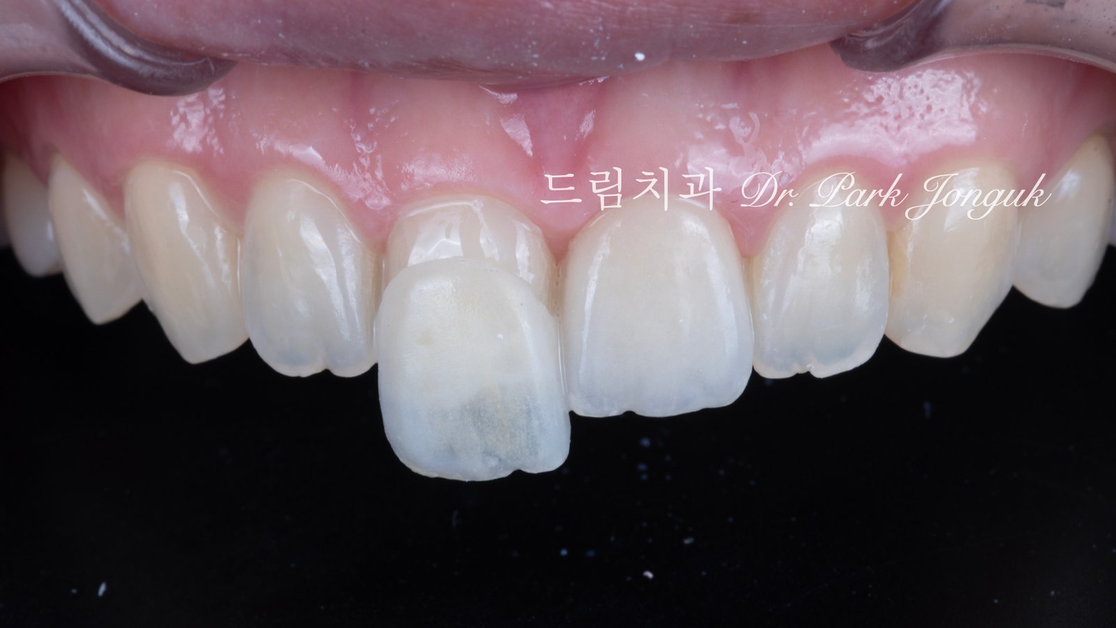 올세라믹 크라운 재시술과 무삭제 라미네이트 치료