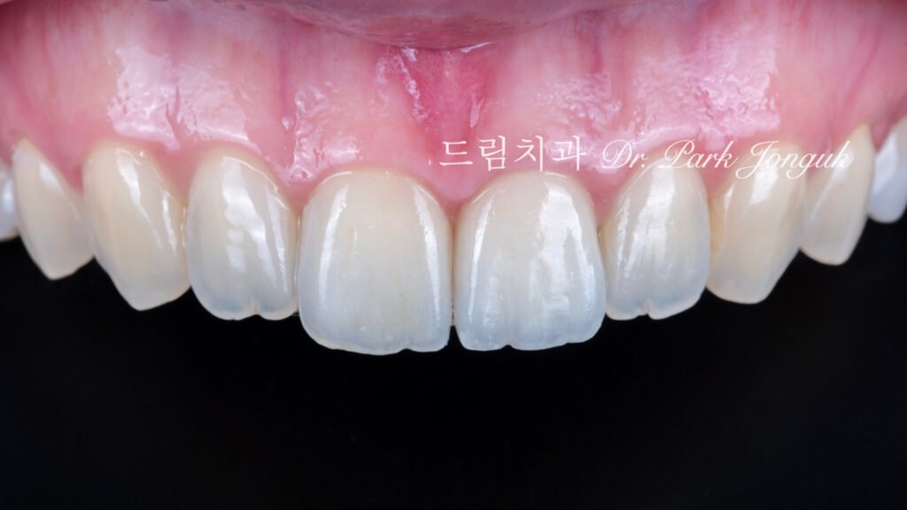 올세라믹 크라운 재시술과 무삭제 라미네이트 치료