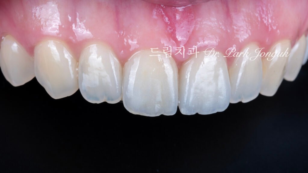 올세라믹 크라운 재시술과 무삭제 라미네이트 치료