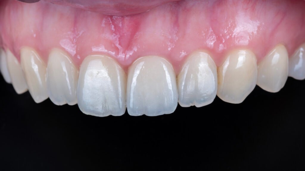 올세라믹 크라운 재시술과 무삭제 라미네이트 치료