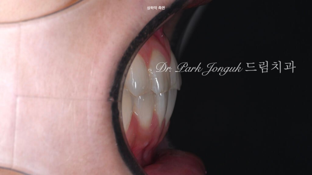 앞니라미네이트, 무삭제라미네이트, 앞니마모치료, 최소삭제라미네이트, 앞니심미보철, 압구정드림치과, 박종욱원장, 보존과전문의, 라미네이트잘하는곳, 치아정밀진단, 핸드메이드보철, 앞니심미재건