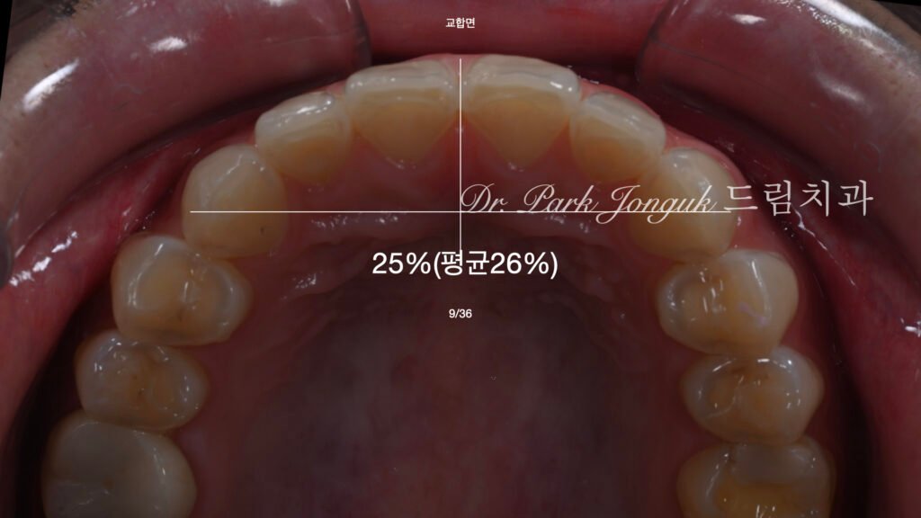앞니라미네이트, 무삭제라미네이트, 앞니마모치료, 최소삭제라미네이트, 앞니심미보철, 압구정드림치과, 박종욱원장, 보존과전문의, 라미네이트잘하는곳, 치아정밀진단, 핸드메이드보철, 앞니심미재건