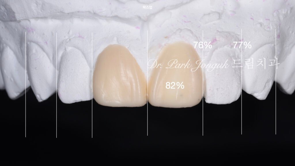 앞니라미네이트, 무삭제라미네이트, 앞니마모치료, 최소삭제라미네이트, 앞니심미보철, 압구정드림치과, 박종욱원장, 보존과전문의, 라미네이트잘하는곳, 치아정밀진단, 핸드메이드보철, 앞니심미재건