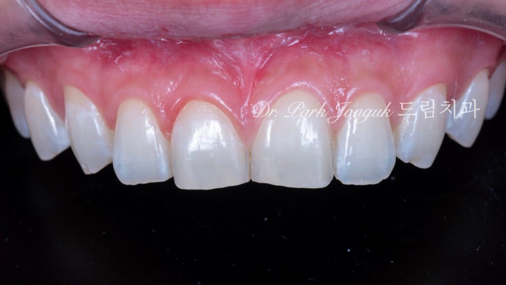 앞니라미네이트, 무삭제라미네이트, 앞니마모치료, 최소삭제라미네이트, 앞니심미보철, 압구정드림치과, 박종욱원장, 보존과전문의, 라미네이트잘하는곳, 치아정밀진단, 핸드메이드보철, 앞니심미재건