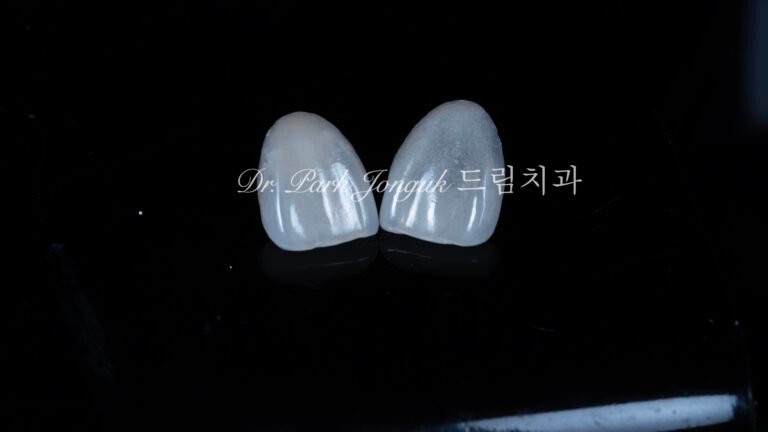 앞니라미네이트, 무삭제라미네이트, 앞니마모치료, 최소삭제라미네이트, 앞니심미보철, 압구정드림치과, 박종욱원장, 보존과전문의, 라미네이트잘하는곳, 치아정밀진단, 핸드메이드보철, 앞니심미재건