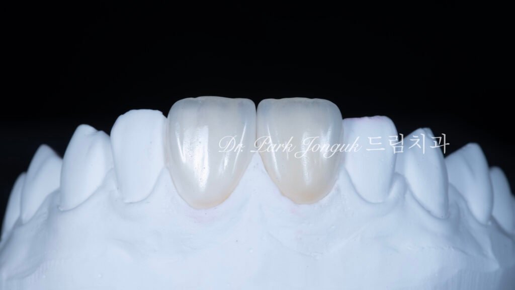앞니라미네이트, 무삭제라미네이트, 앞니마모치료, 최소삭제라미네이트, 앞니심미보철, 압구정드림치과, 박종욱원장, 보존과전문의, 라미네이트잘하는곳, 치아정밀진단, 핸드메이드보철, 앞니심미재건