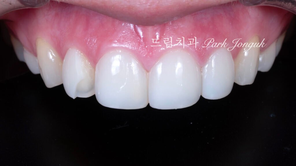 라미네이트 재시술, Laminate Revision, 라미네이트 재치료, Laminate Re-treatment, 자연스러운 라미네이트, Natural Laminate, 레이저 라미네이트 제거, Laser Laminate Removal, 과대 크기 교정, Oversized Correction