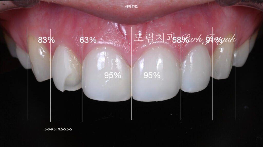 라미네이트 재시술, Laminate Revision, 라미네이트 재치료, Laminate Re-treatment, 자연스러운 라미네이트, Natural Laminate, 레이저 라미네이트 제거, Laser Laminate Removal, 과대 크기 교정, Oversized Correction