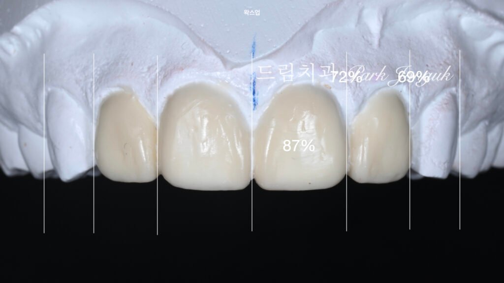 라미네이트 재시술, Laminate Revision, 라미네이트 재치료, Laminate Re-treatment, 자연스러운 라미네이트, Natural Laminate, 레이저 라미네이트 제거, Laser Laminate Removal, 과대 크기 교정, Oversized Correction