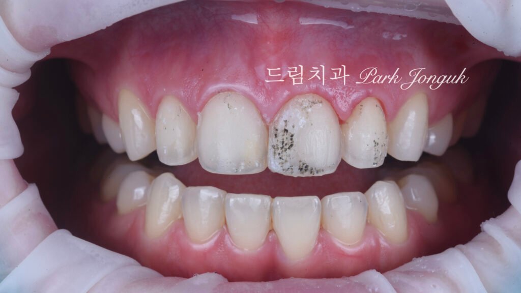 라미네이트 재시술, Laminate Revision, 라미네이트 재치료, Laminate Re-treatment, 자연스러운 라미네이트, Natural Laminate, 레이저 라미네이트 제거, Laser Laminate Removal, 과대 크기 교정, Oversized Correction