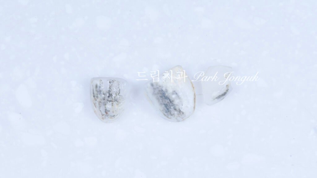 라미네이트 재시술, Laminate Revision, 라미네이트 재치료, Laminate Re-treatment, 자연스러운 라미네이트, Natural Laminate, 레이저 라미네이트 제거, Laser Laminate Removal, 과대 크기 교정, Oversized Correction