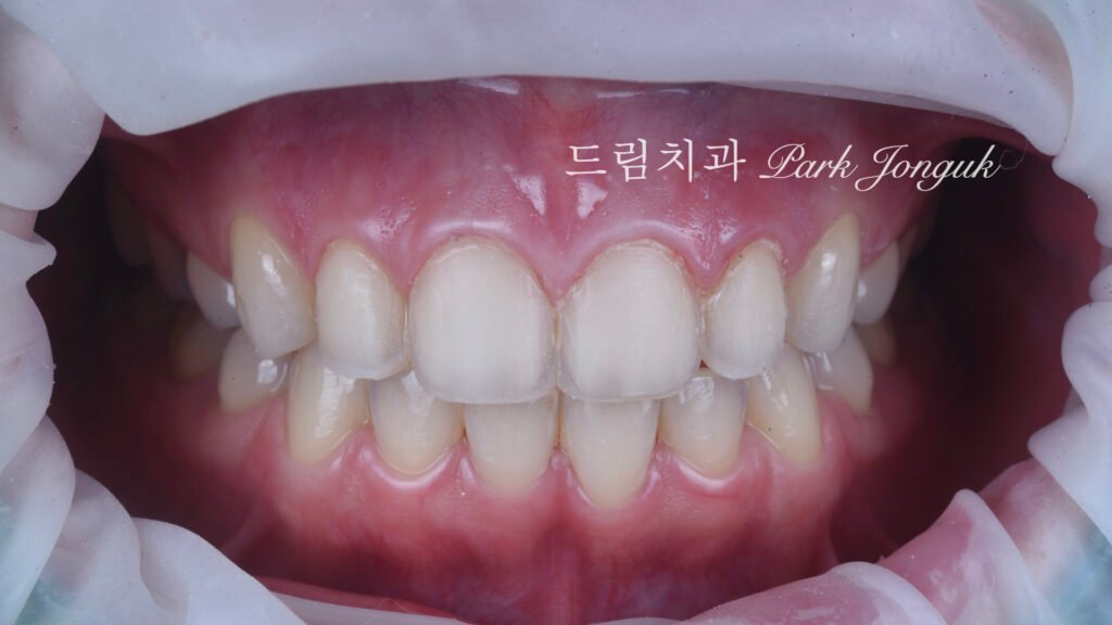 라미네이트 재시술, Laminate Revision, 라미네이트 재치료, Laminate Re-treatment, 자연스러운 라미네이트, Natural Laminate, 레이저 라미네이트 제거, Laser Laminate Removal, 과대 크기 교정, Oversized Correction