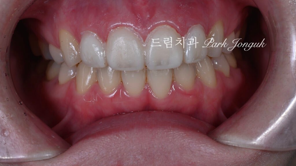 라미네이트 재시술, Laminate Revision, 라미네이트 재치료, Laminate Re-treatment, 자연스러운 라미네이트, Natural Laminate, 레이저 라미네이트 제거, Laser Laminate Removal, 과대 크기 교정, Oversized Correction