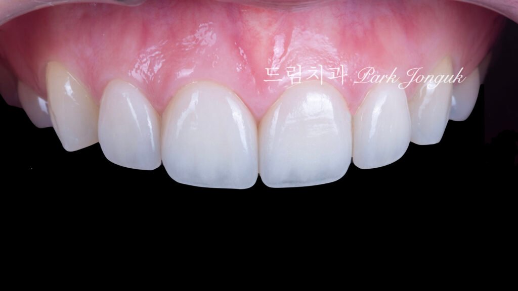 라미네이트 재시술, Laminate Revision, 라미네이트 재치료, Laminate Re-treatment, 자연스러운 라미네이트, Natural Laminate, 레이저 라미네이트 제거, Laser Laminate Removal, 과대 크기 교정, Oversized Correction