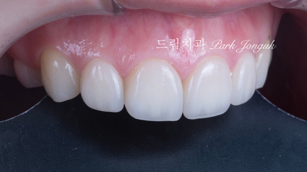 라미네이트 재시술, Laminate Revision, 라미네이트 재치료, Laminate Re-treatment, 자연스러운 라미네이트, Natural Laminate, 레이저 라미네이트 제거, Laser Laminate Removal, 과대 크기 교정, Oversized Correction