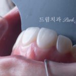 라미네이트 재시술, Laminate Revision, 라미네이트 재치료, Laminate Re-treatment, 자연스러운 라미네이트, Natural Laminate, 레이저 라미네이트 제거, Laser Laminate Removal, 과대 크기 교정, Oversized Correction