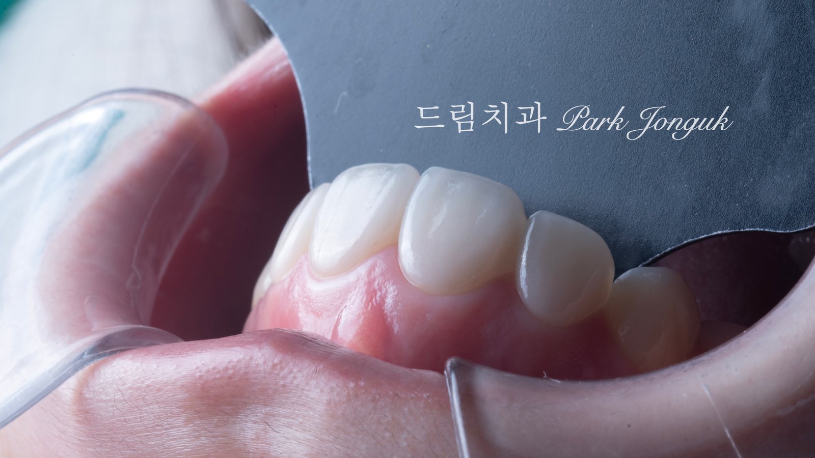 라미네이트 재시술, Laminate Revision, 라미네이트 재치료, Laminate Re-treatment, 자연스러운 라미네이트, Natural Laminate, 레이저 라미네이트 제거, Laser Laminate Removal, 과대 크기 교정, Oversized Correction