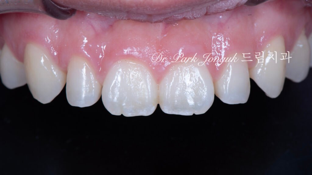 no-prep veneers, minimal prep veneers, porcelain veneers, biomimetic dentistry, cosmetic dentistry, aesthetic dentistry, non invasive dentistry, 무삭제 라미네이트, 라미네이트, 앞니 라미네이트, 벌어진 치아 라미네이트, 왜소치 라미네이트, diastema veneers, microdontia veneers, natural veneers, hand layered veneers, 강남 라미네이트