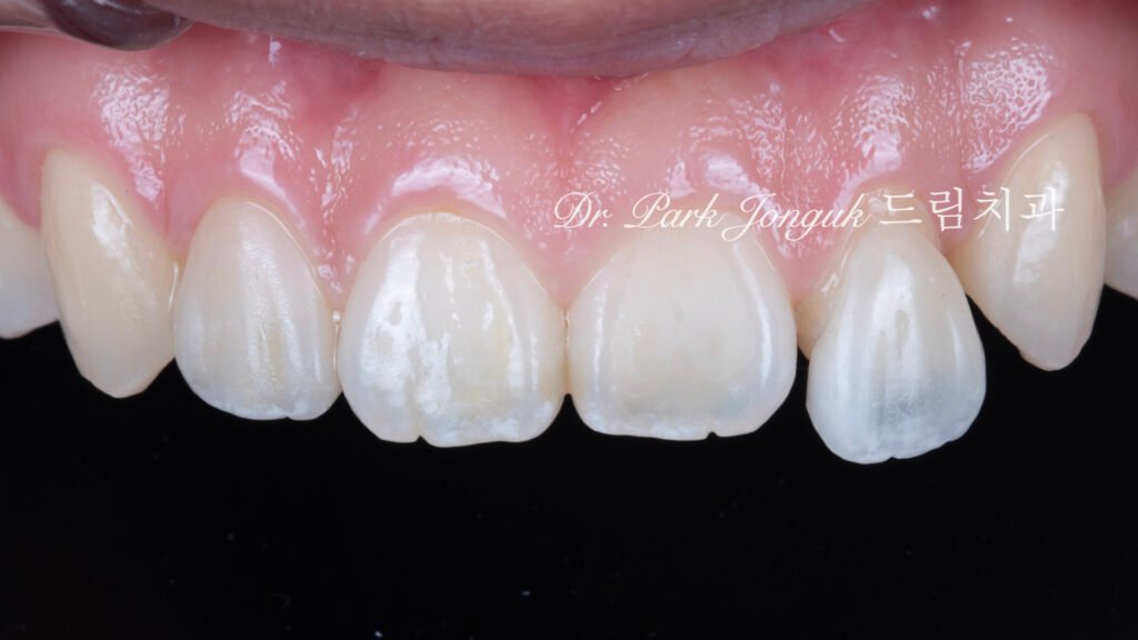 no-prep veneers, minimal prep veneers, porcelain veneers, biomimetic dentistry, cosmetic dentistry, aesthetic dentistry, non invasive dentistry, 무삭제 라미네이트, 라미네이트, 앞니 라미네이트, 벌어진 치아 라미네이트, 왜소치 라미네이트, diastema veneers, microdontia veneers, natural veneers, hand layered veneers, 강남 라미네이트