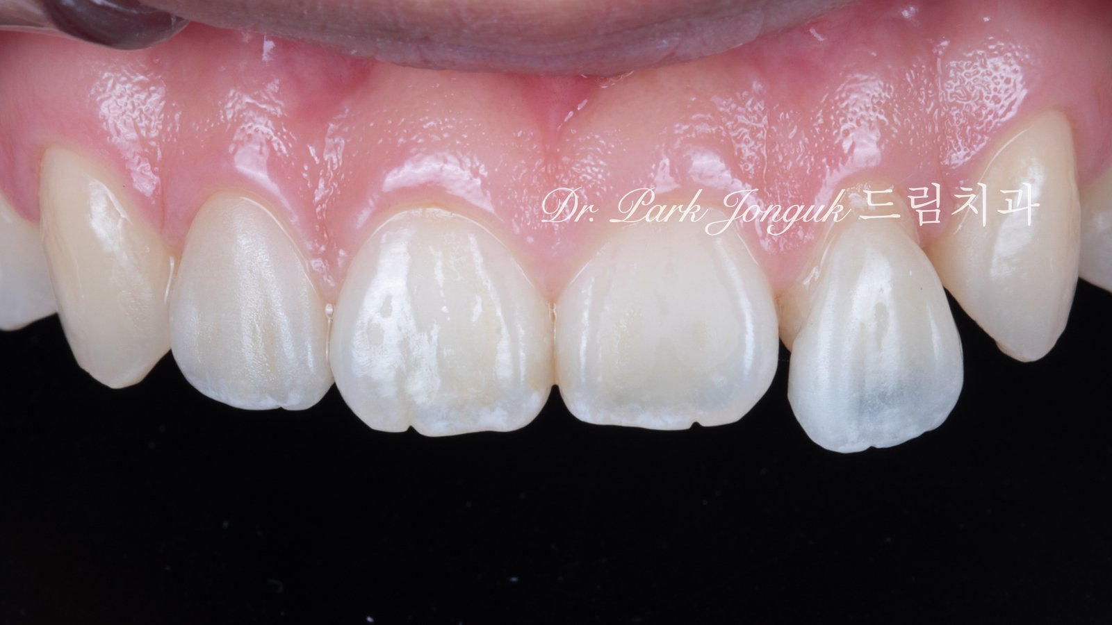 no-prep veneers, minimal prep veneers, porcelain veneers, biomimetic dentistry, cosmetic dentistry, aesthetic dentistry, non invasive dentistry, 무삭제 라미네이트, 라미네이트, 앞니 라미네이트, 벌어진 치아 라미네이트, 왜소치 라미네이트, diastema veneers, microdontia veneers, natural veneers, hand layered veneers, 강남 라미네이트