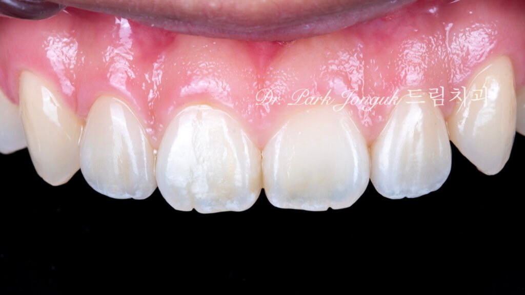 no-prep veneers, minimal prep veneers, porcelain veneers, biomimetic dentistry, cosmetic dentistry, aesthetic dentistry, non invasive dentistry, 무삭제 라미네이트, 라미네이트, 앞니 라미네이트, 벌어진 치아 라미네이트, 왜소치 라미네이트, diastema veneers, microdontia veneers, natural veneers, hand layered veneers, 강남 라미네이트