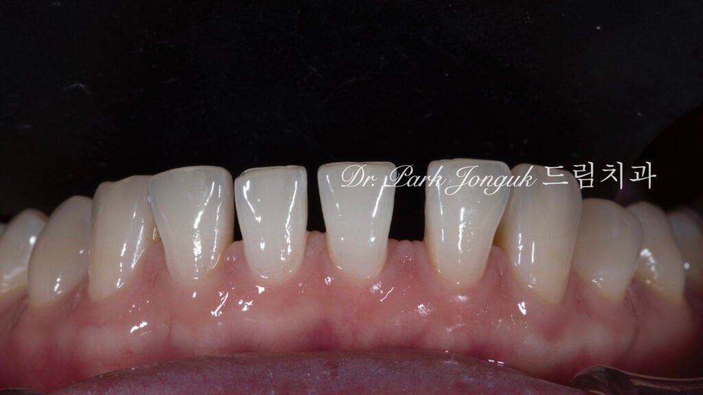 no-prep veneers, minimal prep veneers, porcelain veneers, biomimetic dentistry, cosmetic dentistry, aesthetic dentistry, non invasive dentistry, 무삭제 라미네이트, 라미네이트, 앞니 라미네이트, 벌어진 치아 라미네이트, 왜소치 라미네이트, diastema veneers, microdontia veneers, natural veneers, hand layered veneers, 강남 라미네이트